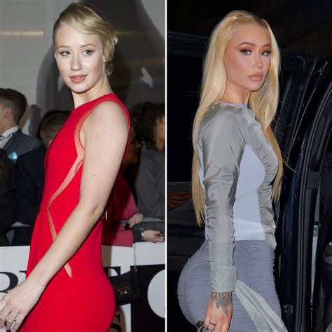 Plastic surgeon claims Iggy Azaleas bum implants。